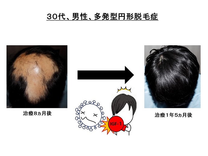 円形脱毛症　病院